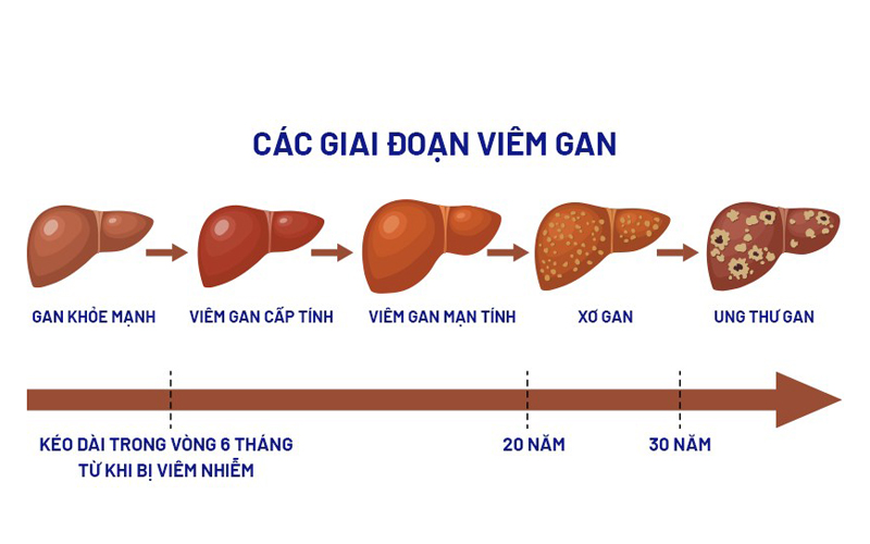 cac giai doan viem gan